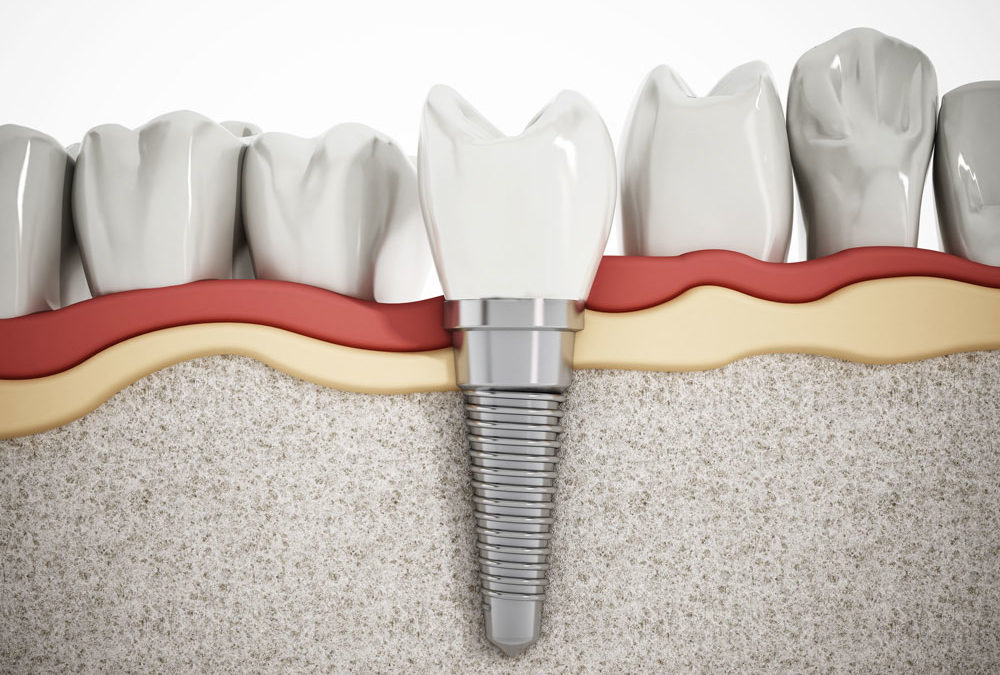 Why Should You Consider Dental Implants?