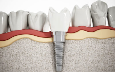 Why Should You Consider Dental Implants?