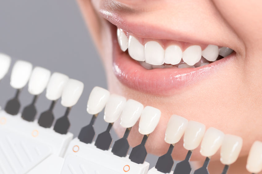 Dental Implants – Orsatti Dental San Antonio