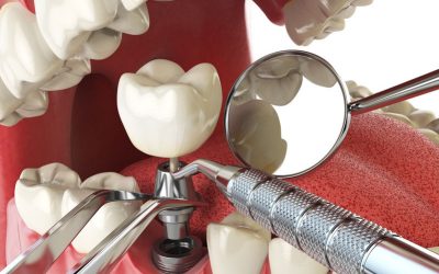 Dental Implants – Orsatti Dental