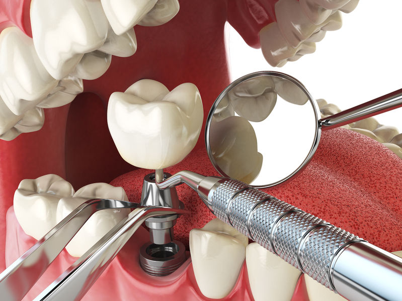 Dental Implants – Orsatti Dental