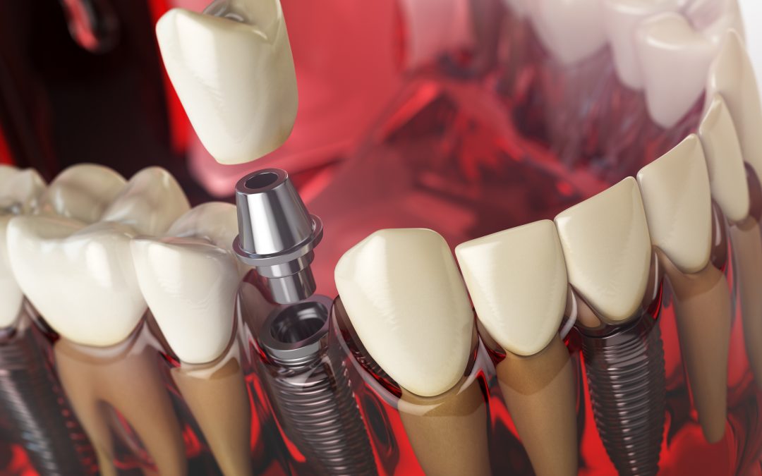 DENTAL IMPLANTS VS DENTURES.WHAT’S THE DIFFERENCE?