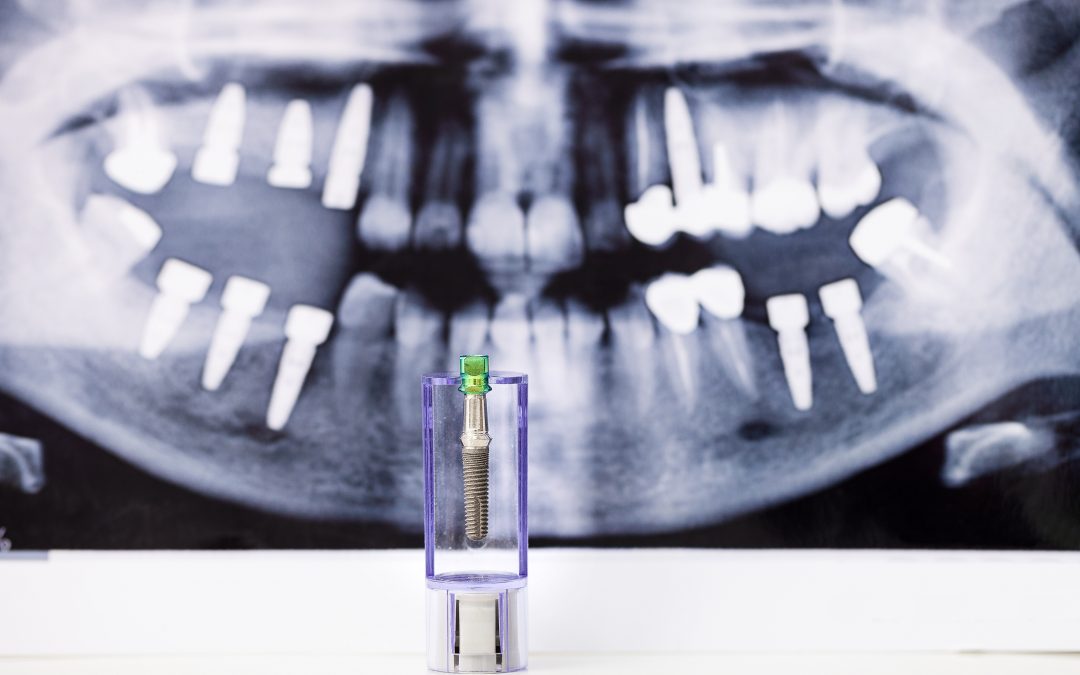 Why Should You Consider Dental Implants?