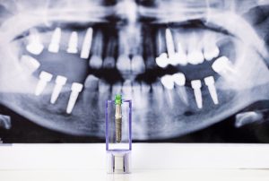 Dental implant and radiography