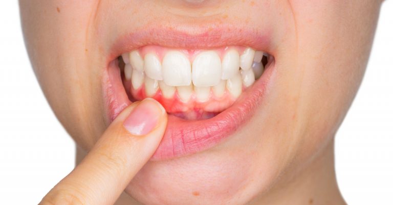 Orsatti Dental - Gum Diseases