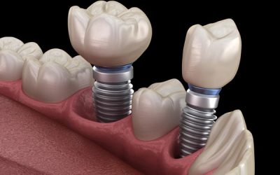 Dental Implant Tips