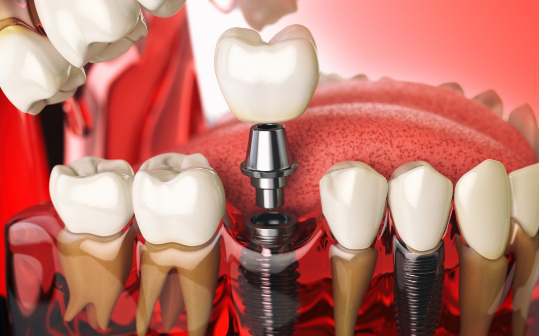 Help With Dental Implants