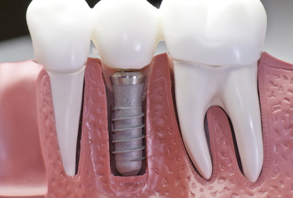Dental Implants San Antonio
