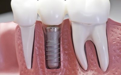 Dental Implants San Antonio