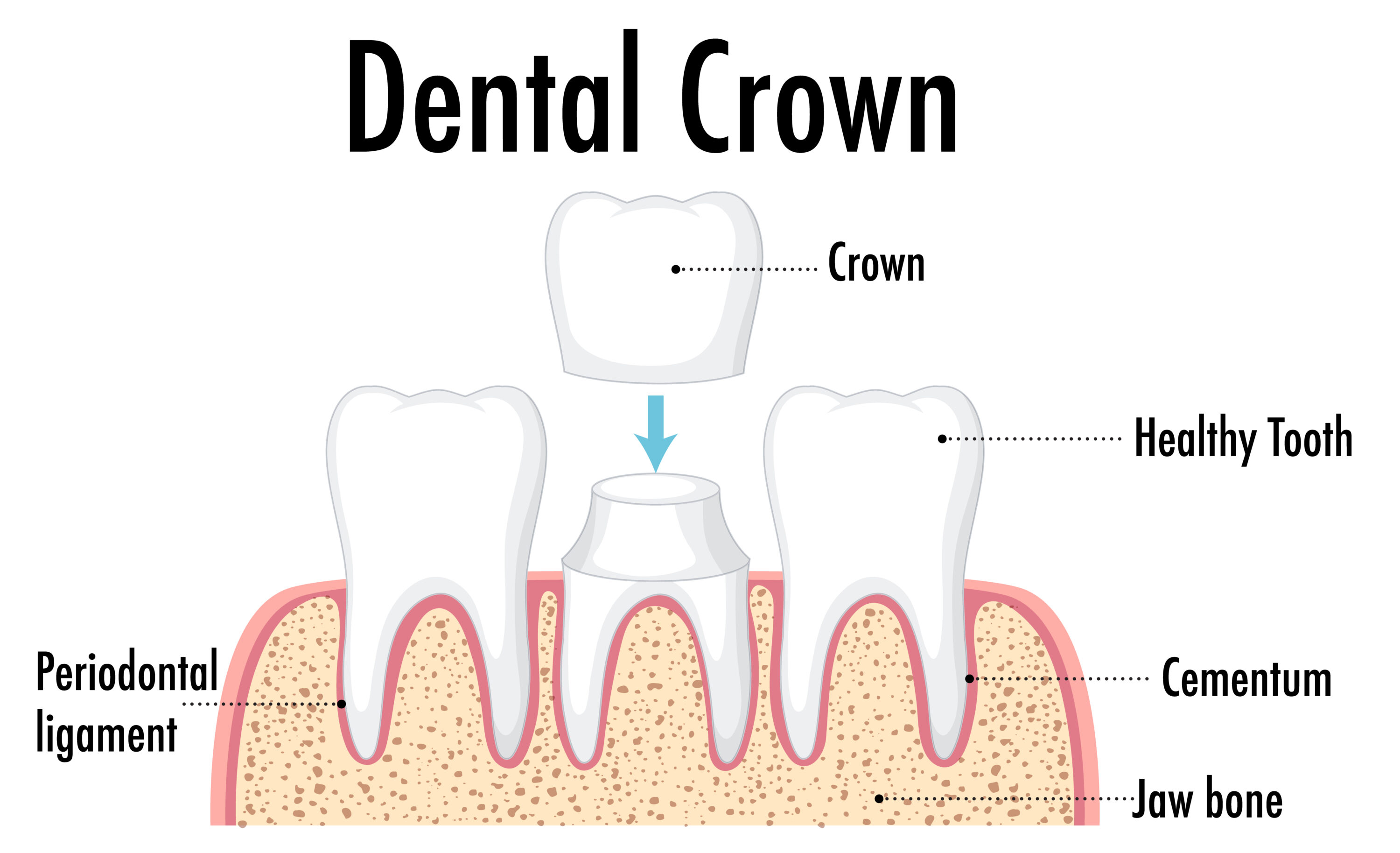 Infographic of human in dental crown