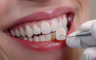 Can Veneers Fix Permanent Tooth Discoloration and Small Gaps?