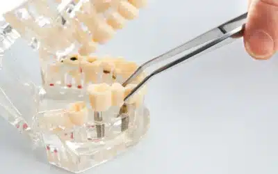 Can I Get a Single-Tooth Implant If I’ve Been Missing a Tooth for Years?