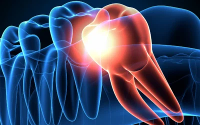 Can Wisdom Teeth Removal Prevent Future Orthodontic Relapse in San Antonio?